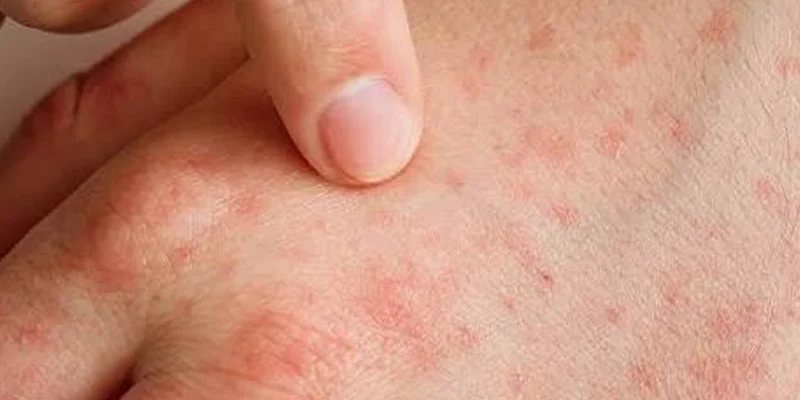 Atopik Dermatit