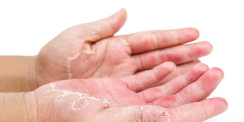 Kontakt Dermatit
