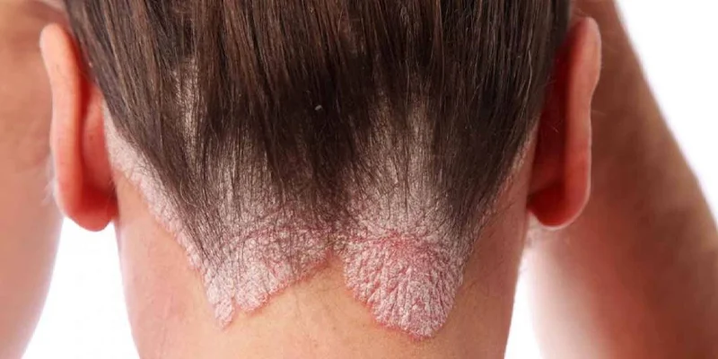 Sedef (Psoriasis) Hastalığı