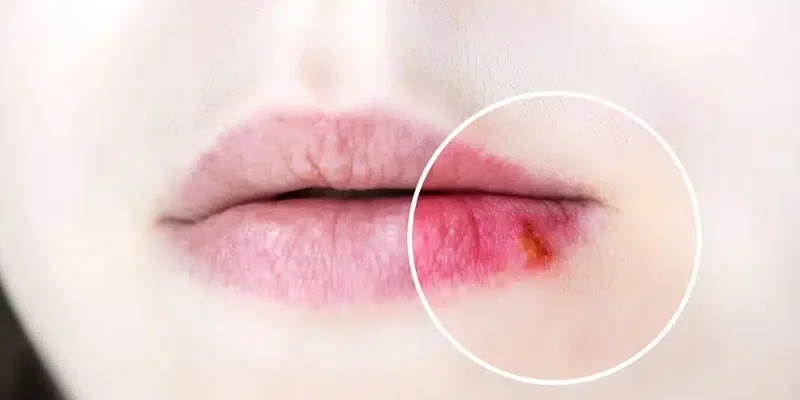 Uçuk (Herpes)