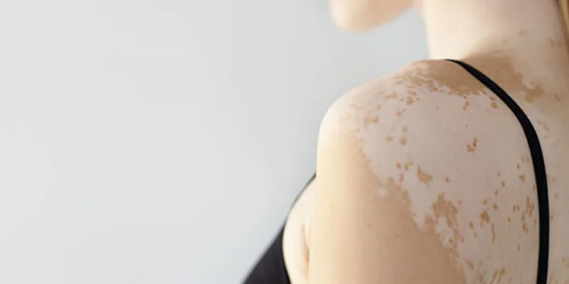 Vitiligo (Ala) Hastalığı
